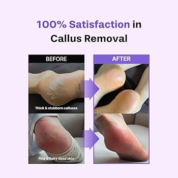Baren Callus Remover Kit for Feet: File & Spray